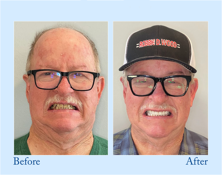 HEATWOLF® - Premium Customized Full Denture Set🦷-🥑🥑The Royal London Dental Hospital accreditation(🏆Limited Time Discount Last 30 Minutes🏆)