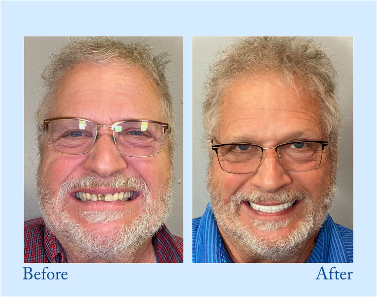 HEATWOLF® - Premium Customized Full Denture Set🦷-🥑🥑The Royal London Dental Hospital accreditation(🏆Limited Time Discount Last 30 Minutes🏆)